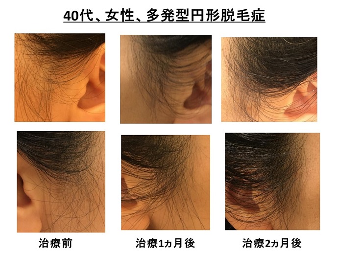 円形脱毛症　病院